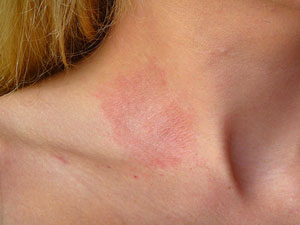 Irritant+contact+dermatitis+pictures