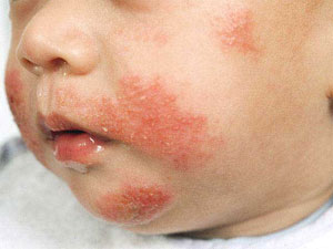 allergy-infantile-eczema