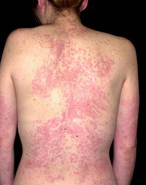 What Are The Signs And Symptoms Of Hives?